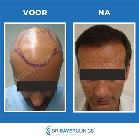 Eetgewoonten Voor Optimale Genezing Na Haartransplantatie