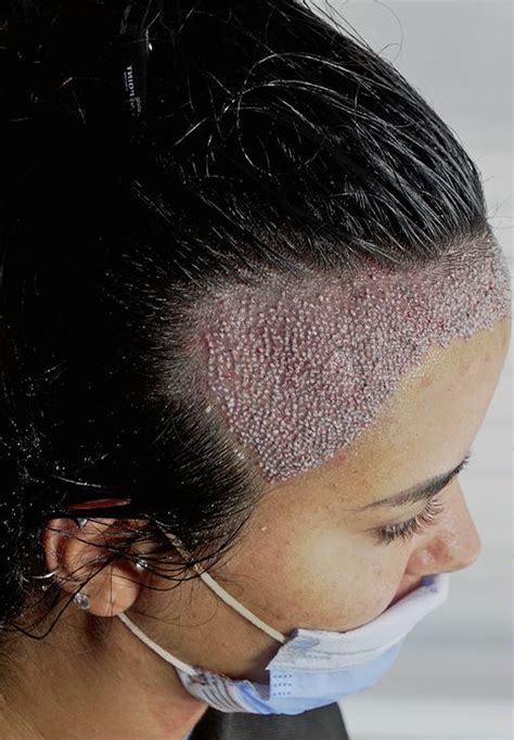 Kunnen Vrouwen ook Haartransplantaties Ondergaan?