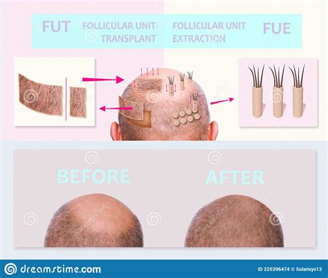 Verschillen tussen FUE en FUT Haartransplantatie Methoden