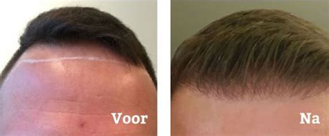 Wat Is Haartransplantatie En Hoe Werkt Het?