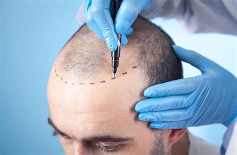 Wat Zijn de Kosten van Een Haartransplantatie in Nederland?