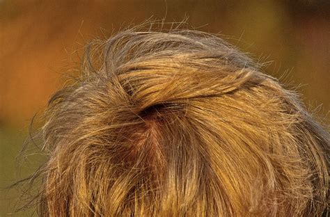 Wat Zijn De Kosten Van Een Haartransplantatie?