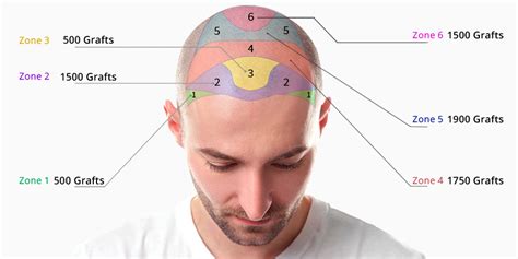 Haartransplantatie Kosten: Wat Is De Totaalprijs?