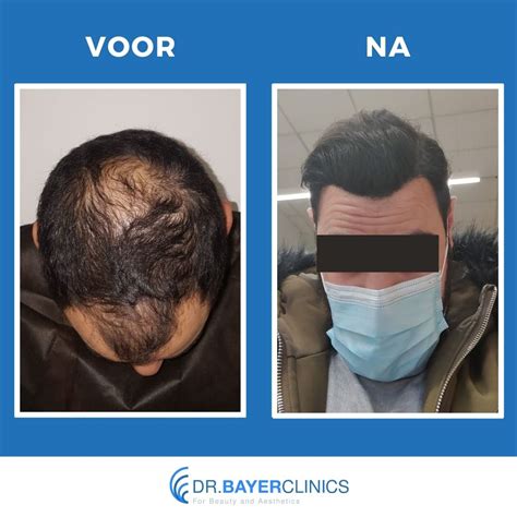 Haartransplantatie Voor En Na: Beoordelingen Van Klinieken