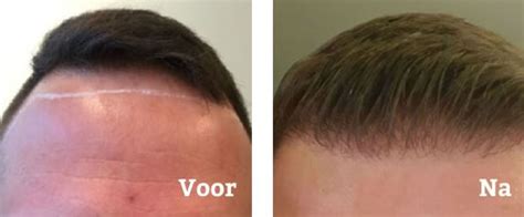 Haartransplantatie Voor En Na: Hoe Kies Je De Juiste Haarlijn?