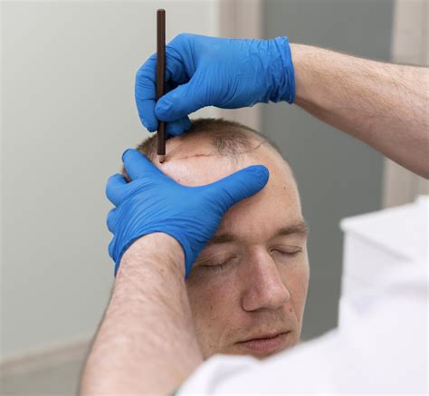 De Psychologie Achter Haarverlies En Haartransplantatie