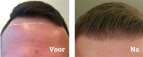 Haartransplantatie Behandeling: Wanneer Is Het Tijd Voor Actie?