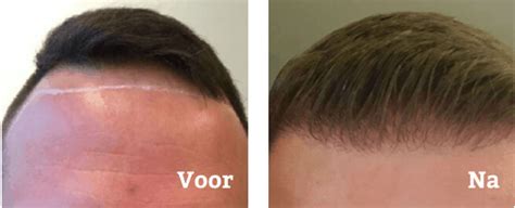 Haartransplantatie En De Impact Op Uw Levensstijl