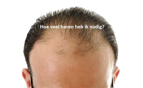 Haartransplantatie Kosten: Hoe Maak Je Een Slimme Keuze?