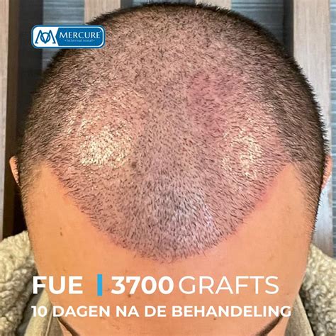 Haartransplantatie Saffier FUE: Wat Maakt Het Anders?