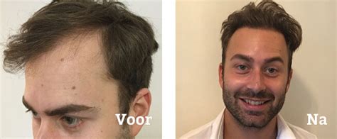 Ervaringen Van Patiënten Na Haartransplantatie