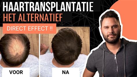 Haartransplantatie Kosten: Hoe Bespaar Je Geld?