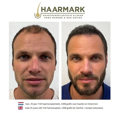 Haartransplantatie Voor En Na Foto's: Wat Je Mag Verwachten