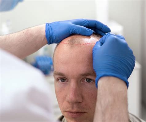 Beperkingen Van Haartransplantatie: Wat Je Moet Weten