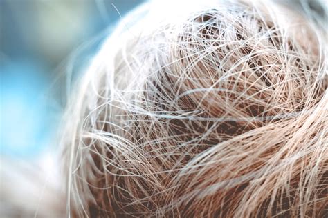 Haartransplantatie En Haargroei: Hoe Werkt Het Eigenlijk?