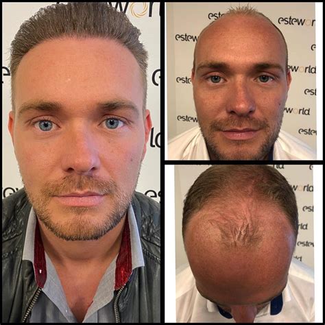Haartransplantatie Ervaringen: Wat Klanten Zeggen