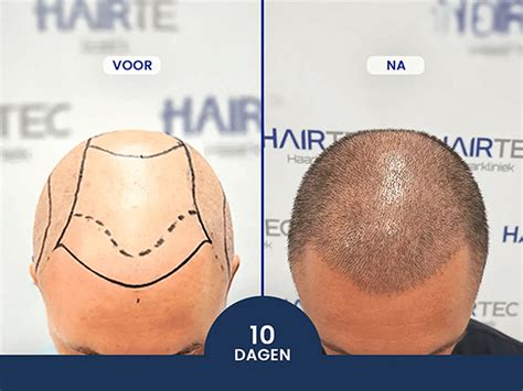 Haartransplantatie Voor Heren: Wat Zijn De Opties?