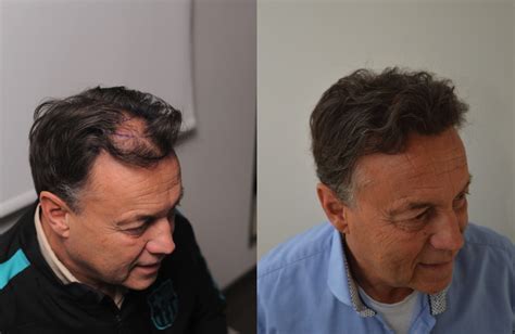 Het Belang Van Consultatie Voor Haartransplantatie