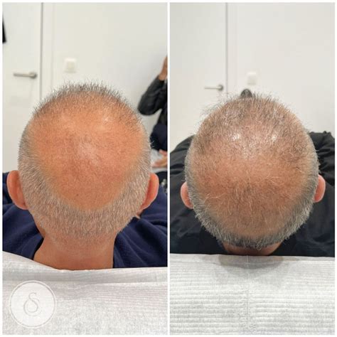 Hoe Je Haartransplantatie Resultaten Voor En Na Kunt Vastleggen
